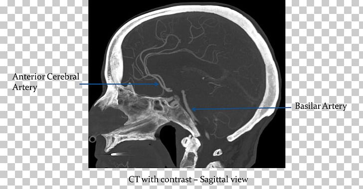 Computed Tomography Circle Of Willis Sagittal Plane Brain Intracranial Aneurysm PNG, Clipart, Anatomy, Aneurysm, Anterior Cerebral Artery, Basal Ganglia, Basilar Artery Free PNG Download
