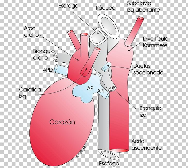 Aberrant Subclavian Artery Aortic Arch Aorta Diverticolo Di Kommerell PNG, Clipart, Anatomy, Angle, Aorta, Aortic Arch, Artery Free PNG Download