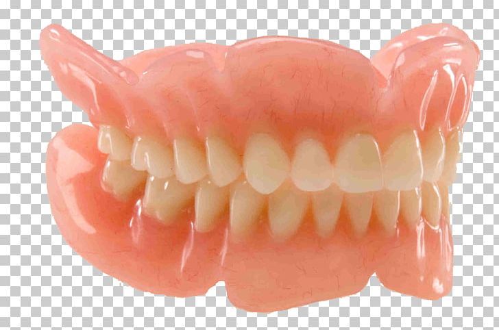 Dentures Dentistry Removable Partial Denture Dental Restoration PNG, Clipart, Bridge, Crown, Den, Dental Implant, Dental Surgery Free PNG Download
