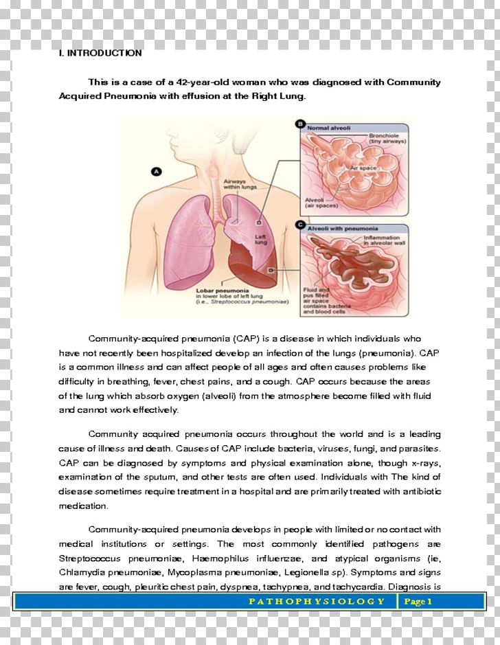 Pneumonia Tuberculosis Lung Disease Infection PNG, Clipart, Bacteria, Bacterial Pneumonia, Disease, Health, Infection Free PNG Download