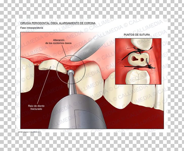 Crown Lengthening Surgery Periodontal Disease Tooth PNG, Clipart, Bone, Crown, Crown Lengthening, Dental Abscess, Dentist Free PNG Download