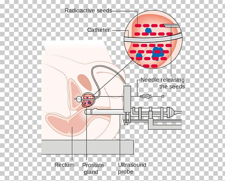 Radiation Therapy Prostate Cancer Brachytherapy Proton Therapy PNG, Clipart, Angle, Area, Benign Prostatic Hyperplasia, Brachytherapy, Disease Free PNG Download