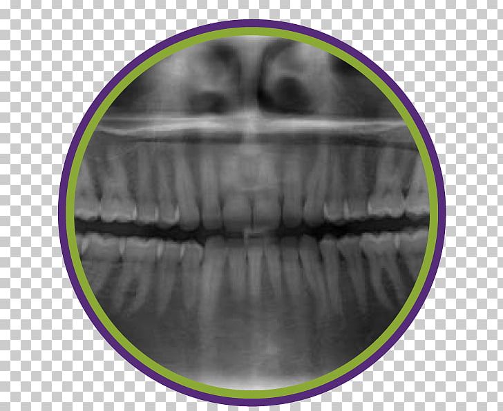 Dentistry Periodontal Disease Tooth Periodontosis Dental Radiography PNG, Clipart, Dental Braces, Dental Radiography, Dental Restoration, Dentistry, Gums Free PNG Download