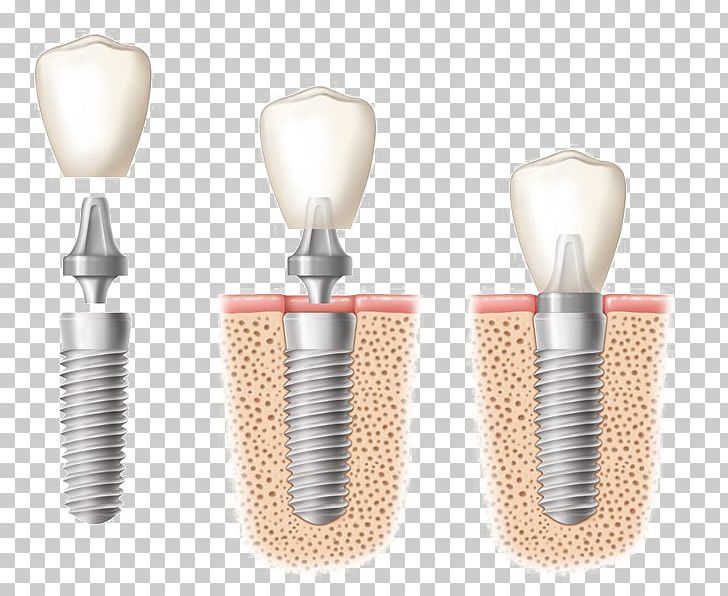 Dental Implant Dentistry Tooth PNG, Clipart, Allon4, Brush, Crown, Dental, Dental Implant Free PNG Download