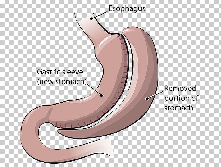 Bariatric Surgery Sleeve Gastrectomy Gastric Bypass Surgery Weight Loss PNG, Clipart, Abdomen, Abdominal Surgery, Angle, Arm, Bariatrics Free PNG Download