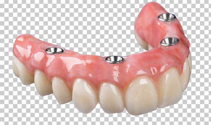Dental Implant Dentures All-on-4 Removable Partial Denture Bridge PNG, Clipart, Allon4, All On 4, Bridge, Cosmetic Dentistry, Crown Free PNG Download