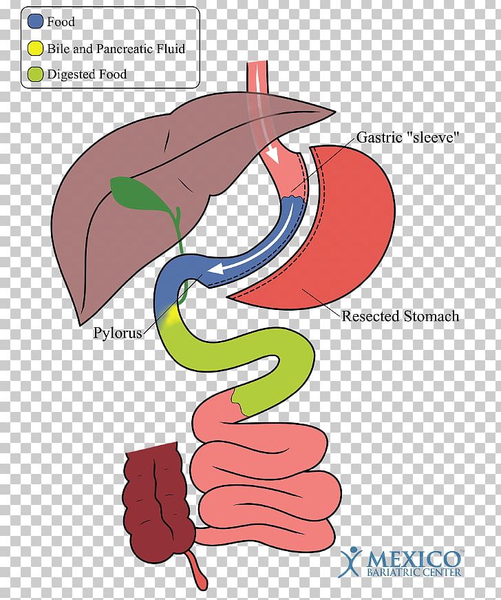 Duodenal Switch Sleeve Gastrectomy Bariatric Surgery Gastric Bypass Surgery PNG, Clipart,  Free PNG Download