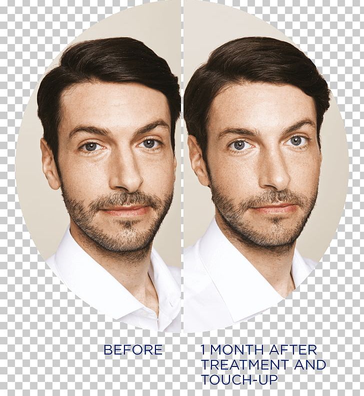 Restylane Wrinkle Beard Botulinum Toxin Dermatology PNG, Clipart, Ageing, Antiaging Cream, Beard, Blepharoplasty, Botulinum Toxin Free PNG Download