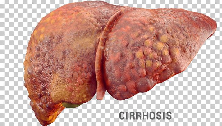 Liver Disease Hepatic Encephalopathy Fatty Liver Hepatitis PNG, Clipart, Animal Fat, Animal Source Foods, Back Bacon, Bayonne Ham, Cause Free PNG Download