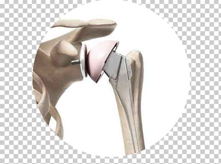 Shoulder Replacement Shoulder Surgery Joint Replacement PNG, Clipart, Angle, Arthroplasty, Arthroscopy, Artificial, Hip Free PNG Download