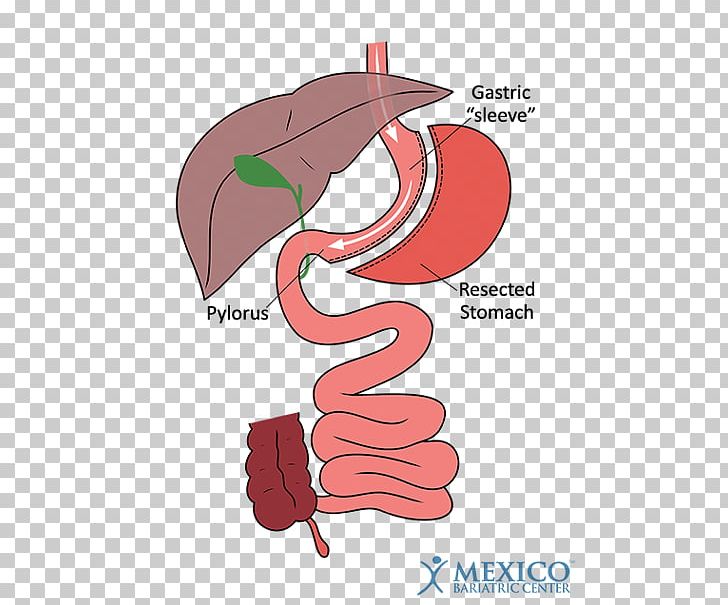 Duodenal Switch Bariatric Surgery Gastric Bypass Surgery Sleeve Gastrectomy PNG, Clipart, Anastomosis, Angle, Arm, Art, Bariatric Surgery Free PNG Download