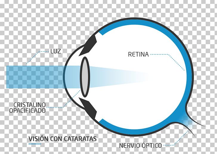 Floater Presbyopia Eye Far-sightedness Near-sightedness PNG, Clipart, Blue, Blurred, Brand, Circle, Communication Free PNG Download