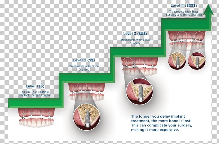 Dental Implant Dentistry Dental Insurance Bridge PNG, Clipart, Bone, Brand, Bridge, Cost, Dental Implant Free PNG Download