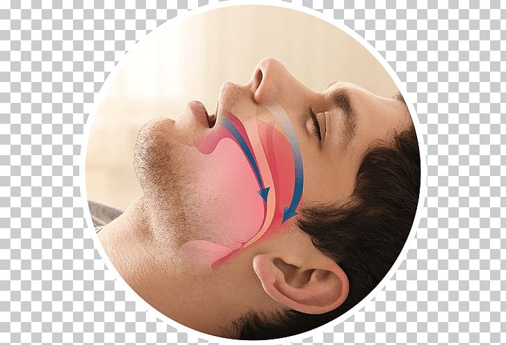 Obstructive Sleep Apnea Snoring Mandibular Advancement Splint Dentist PNG, Clipart, Apnea, Beauty, Cheek, Chin, Dentist Free PNG Download