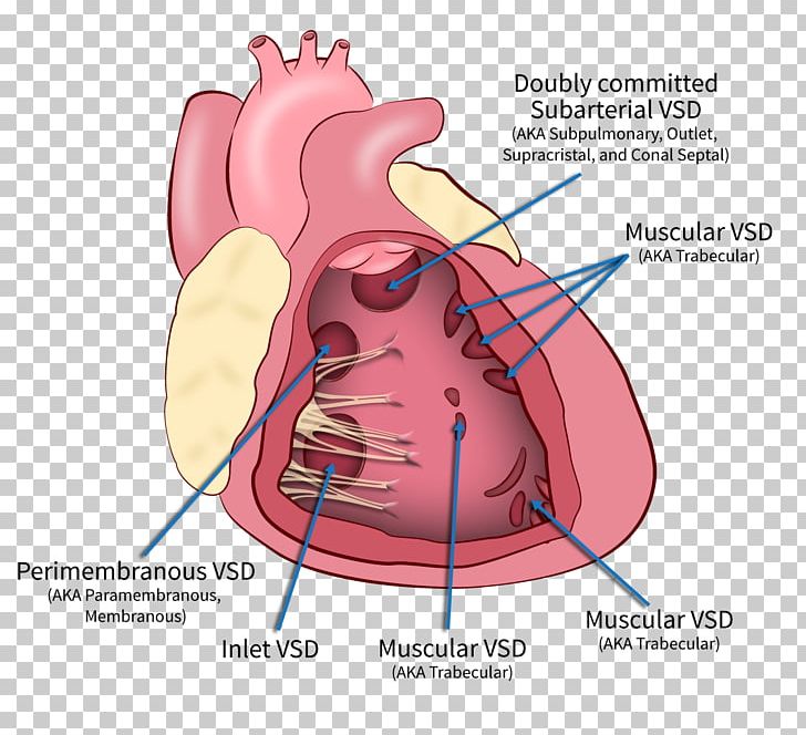 Heart Ventricular Septal Defect Interventricular Septum Ventricle Png