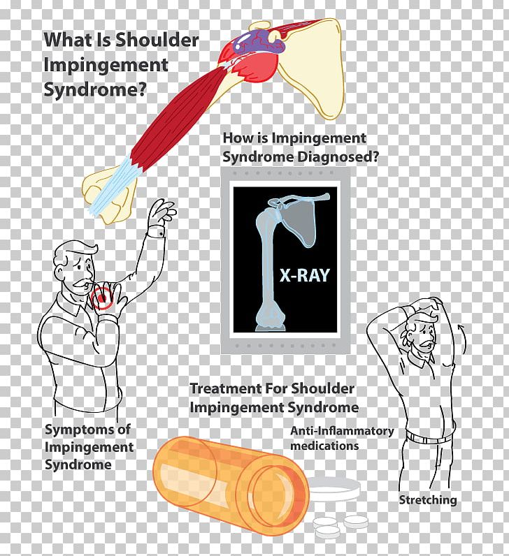 Impingement Syndrome Supraspinatus Muscle Pain Inflammation PNG, Clipart, Angle, Area, Arm, Diagram, Fashion Accessory Free PNG Download