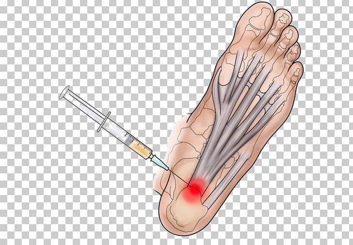 Thumb Plantar Fasciitis Platelet-rich Plasma Therapy Ankle PNG, Clipart, Ache, Ankle, Arm, Ayak, Calcaneal Spur Free PNG Download