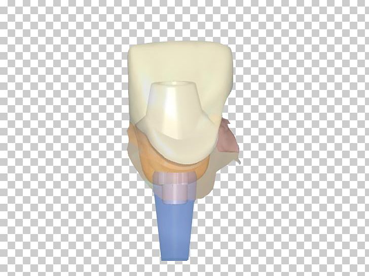 Dental Implant Abutment Crown Zirconium Dioxide PNG, Clipart, Abutment, Bridge, Collar, Crown, Dental Implant Free PNG Download