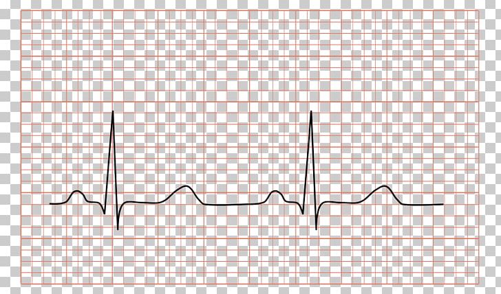 Dynamic Electrocardiography Sinus Rhythm QRS Complex Cardiology PNG, Clipart, Angle, Area, Atrioventricular Node, Chest Pain, Diagram Free PNG Download