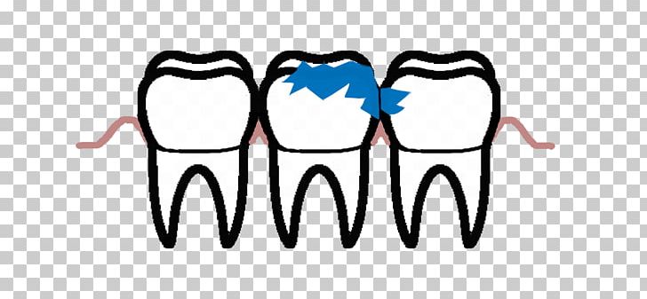 Tooth Decay Periodontal Disease Pulp Endodontics PNG, Clipart, Area, Artwork, Brand, Dental Implant, Dentistry Free PNG Download