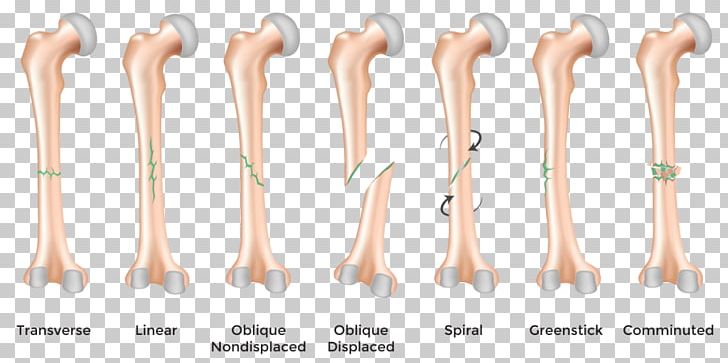 Bone Fracture Bone Healing Greenstick Fracture Injury PNG, Clipart, Ankle Fracture, Arm, Bone, Bone Disease, Bone Fracture Free PNG Download