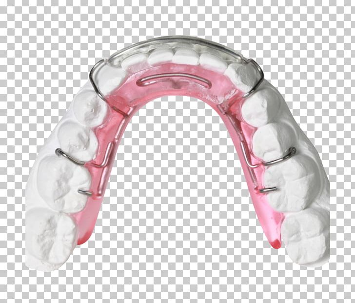 Clear Aligners Orthodontics Orthodontic Technology Jaw Bionator PNG, Clipart, Bionator, Clear Aligners, David Gergen, Dentistry, Gergens Orthodontic Lab Free PNG Download