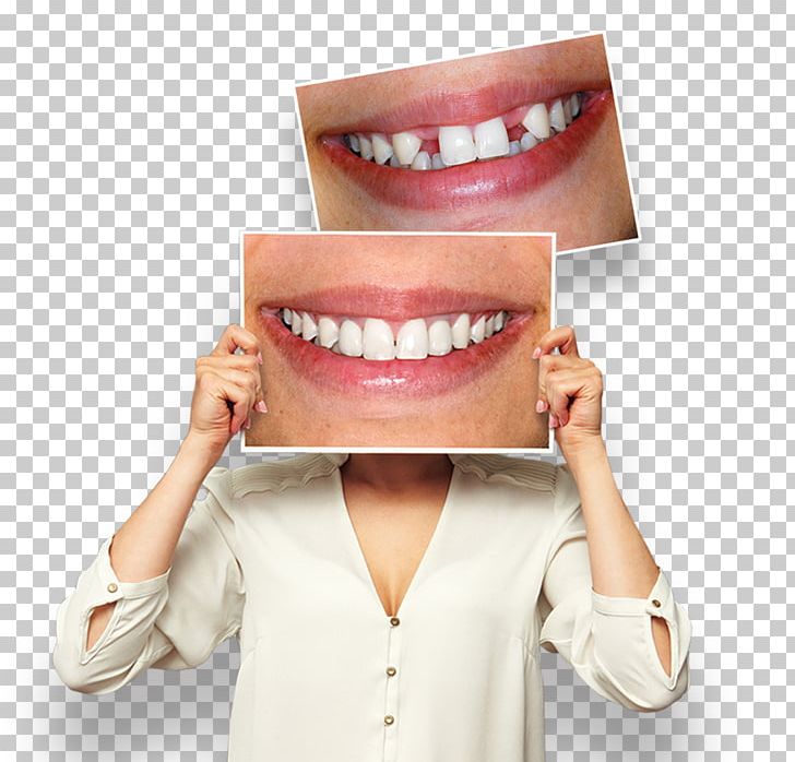 Smile Tooth Whitening Endodontic Therapy Dental Braces Dentistry PNG, Clipart, Chin, Ciudad Real, Civil Guard, Clinic, Dental Free PNG Download