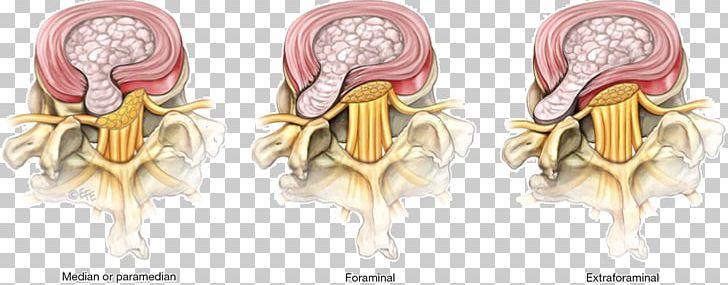 Lumbar Disc Herniation Spinal Disc Herniation Surgery Lumbar Disc Disease Discectomy PNG, Clipart, Ache, Anatomy, Anime, Disc, Discectomy Free PNG Download