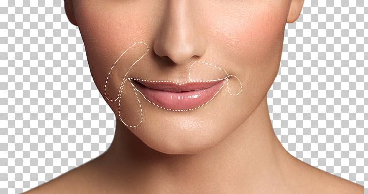 Lip Augmentation Restylane Wrinkle Botulinum Toxin PNG, Clipart, Beauty, Botulinum Toxin, Cheek, Chin, Closeup Free PNG Download