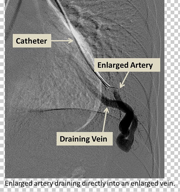 Cerebral Arteriovenous Malformation Lung Embolization Angiography PNG, Clipart, Angiography, Angle, Arteriovenous Malformation, Artery, Black And White Free PNG Download