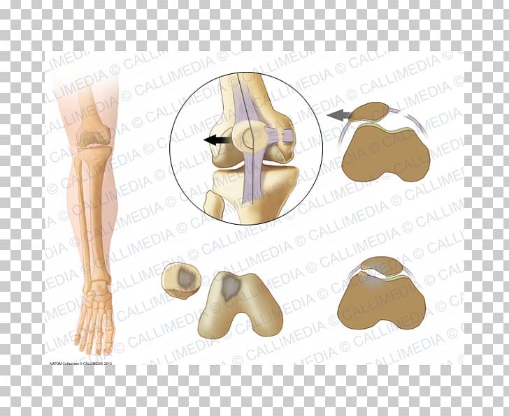 Shoulder Patella Bone Subluxation Joint Dislocation PNG, Clipart, 360 Degrees, Arm, Bone, Dimension, Ear Free PNG Download