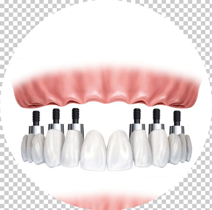 Dental Implant Dentistry Bridge Dentures PNG, Clipart, Allon4, Bridge, Crown, Dental Implant, Dental Restoration Free PNG Download