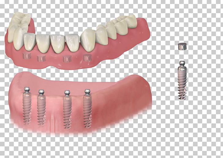 Dental Implant Dentistry Dentures Removable Partial Denture PNG, Clipart, Bridge, Cosmetic Dentistry, Dental, Dental Extraction, Dental Restoration Free PNG Download