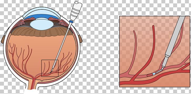 Central Retinal Vein Occlusion Vascular Occlusion PNG, Clipart, Arm, Blood Vessel, Central Retinal Artery, Central Retinal Vein, Central Retinal Vein Occlusion Free PNG Download
