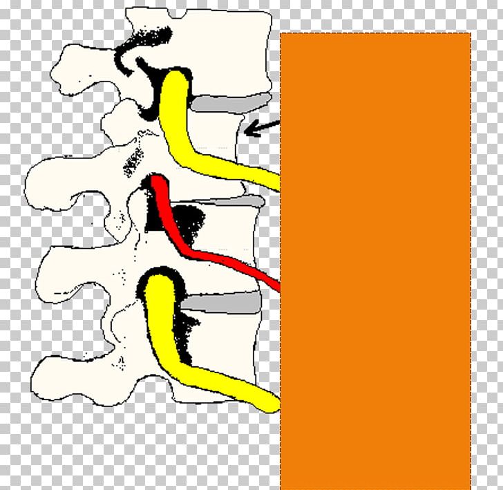 Phoenix Mountain Chiropractic Life Center Spinal Adjustment Vertebral Subluxation PNG, Clipart, Angle, Area, Art, Back Pain, Cartoon Free PNG Download