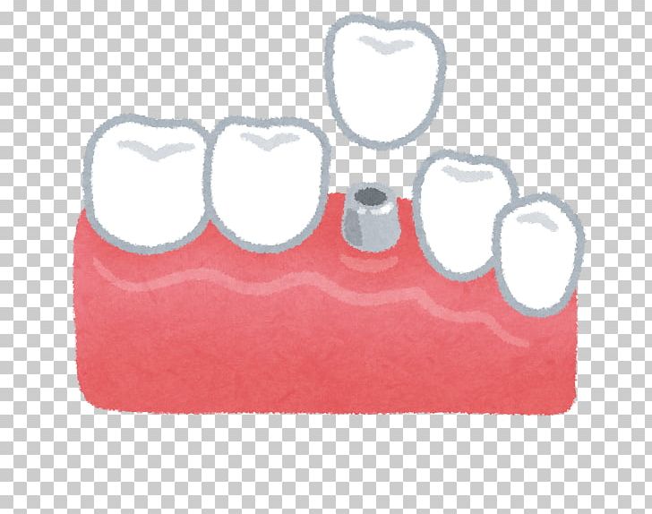 Dentist Dental Implant Therapy Dentures PNG, Clipart, Dental Implant, Dentist, Dentistry, Dentures, Handbag Free PNG Download