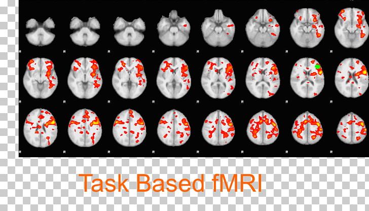 Functional Magnetic Resonance Imaging Brain Default Mode Network Functional Neuroimaging PNG, Clipart, Brain, Default Mode Network, Functional Neuroimaging, Health, Magnetic Resonance Imaging Free PNG Download