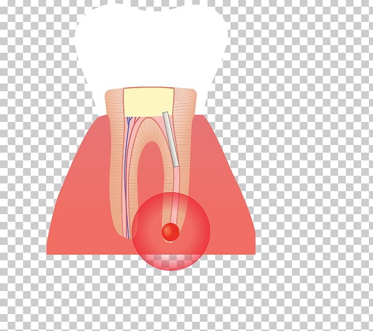 Root Canal Infection Tooth Poster PNG, Clipart, Bed, Com, Fourposter Bed, Infection, Orange Free PNG Download