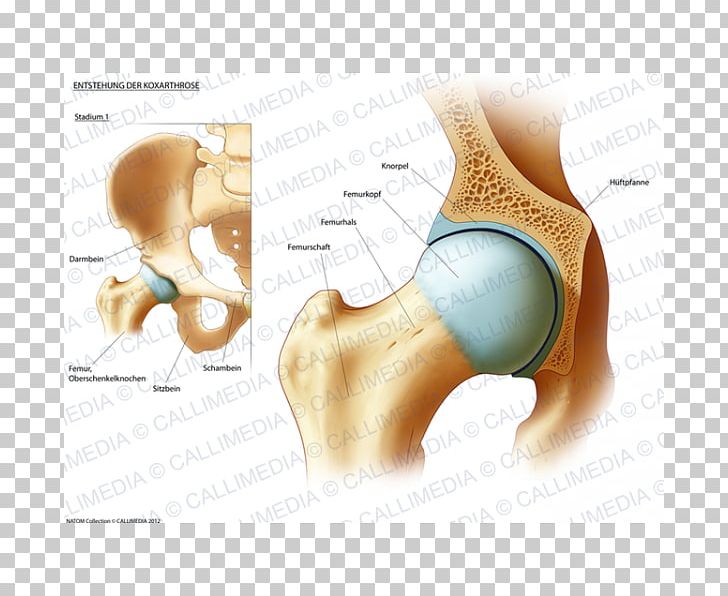 Hip Rheumatoid Arthritis Therapy Femur PNG, Clipart, Abdomen, Arthritis, Bone, Chest, Chronic Childhood Arthritis Free PNG Download