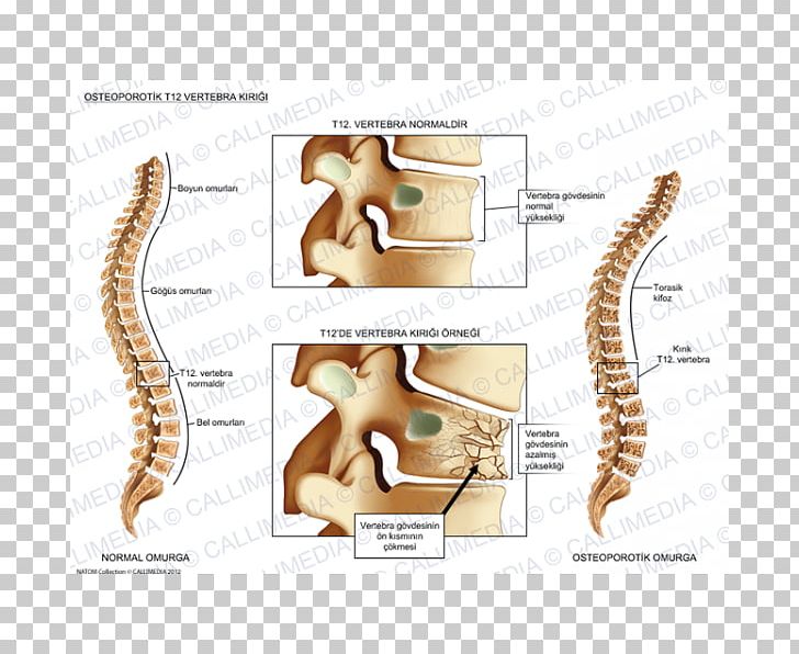 Vertebral Column Bone Fracture Vertebral Compression Fracture Anatomy PNG, Clipart, Anatomy, Bone, Bone Fracture, Ear, Fauna Free PNG Download