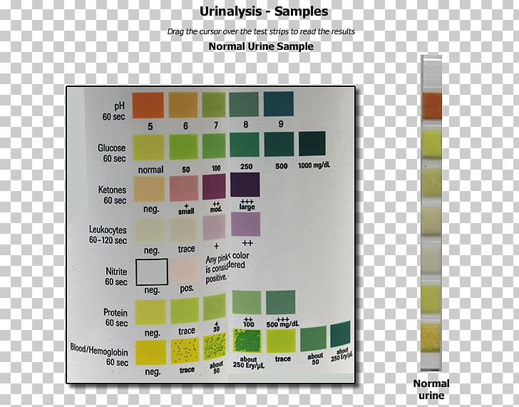 Human Anatomy & Physiology Clinical Urine Tests Urine Test Strip Ketone Bodies PNG, Clipart, Blood, Blood Sugar, Clinical Urine Tests, Diabetes In Cats, Diabetes Mellitus Free PNG Download