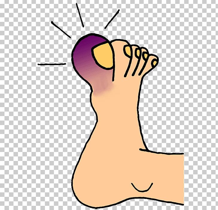 Toe Nail Foot Onychocryptosis PNG, Clipart, Ankle, Area, Art, Artwork, Bunion Free PNG Download