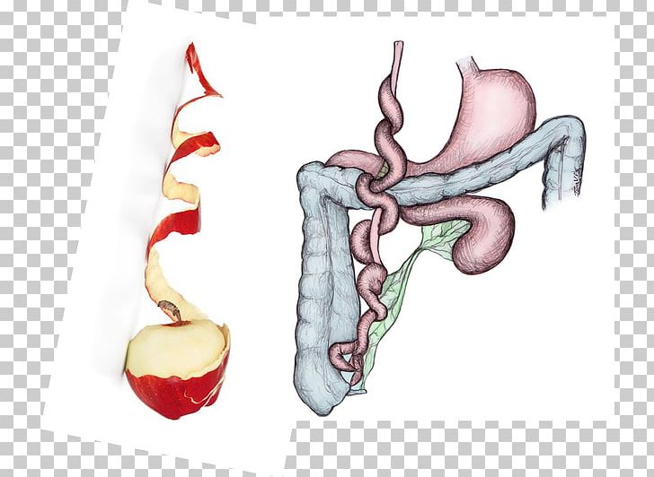 Intestinal Atresia Large Intestine Jejunum Stenosis PNG, Clipart, Abdominal Pain, Atresia, Birth Defect, Disease, Duodenum Free PNG Download