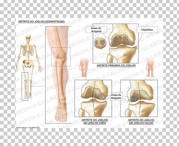 Knee Osteoarthritis Knee Osteoarthritis Knee Arthritis PNG, Clipart, Abdomen, Arm, Arthritis, Bone, Ear Free PNG Download