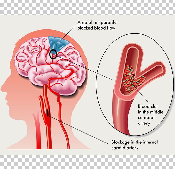 Transient Ischemic Attack Ischemic Stroke Ischemia Symptom PNG, Clipart, Artery, Atherosclerosis, Blood, Blood Vessel, Brain Free PNG Download