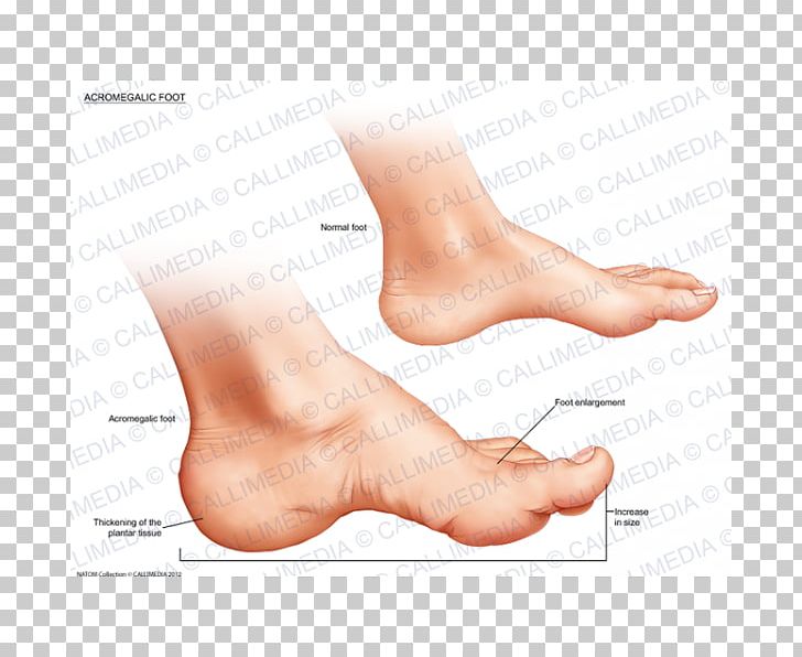 Thumb Acromegaly Foot Ankle Endocrinology PNG, Clipart, Acromegaly, Ankle, Endocrinology, Finger, Flat Feet Free PNG Download