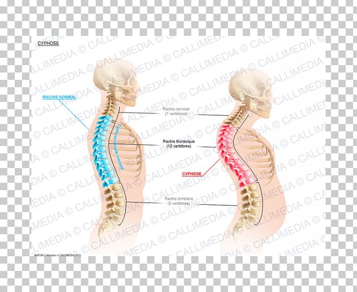 Kyphosis Lordosis Cervical Vertebrae Vertebral Column Scoliosis PNG, Clipart, Arm, Body Jewelry, Cervical Vertebrae, Digestif, Ear Free PNG Download