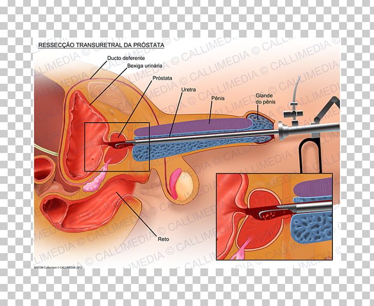 Transurethral Resection Of The Prostate Transurethral Resection Of The Prostate Surgery Prostate Cancer PNG, Clipart, Angle, Benign Prostatic Hyperplasia, Bladder Cancer, Bowed String Instrument, Cello Free PNG Download