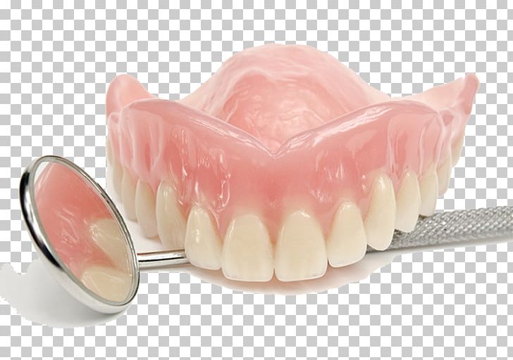 Dentures Prosthodontics Dentistry Tooth PNG, Clipart, Cadcam Dentistry, Dental Implant, Dental Surgery, Dentist, Dentistry Free PNG Download