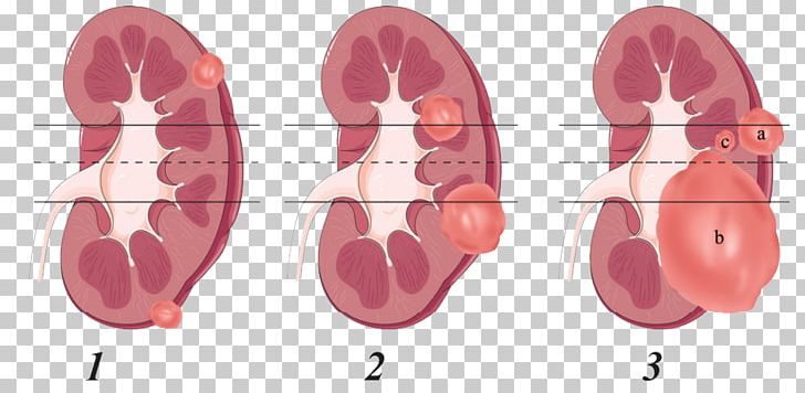 Kidney Tumour Nephrectomy Renal Cell Carcinoma Anatomy PNG, Clipart, Anatomy, Cancer, Ear, Finger, Hilum Free PNG Download